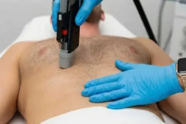 Rinnan iho ennen laserkarvanpoistoa